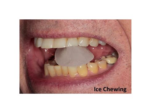 Ice Chewing | Delmarva Dental Services