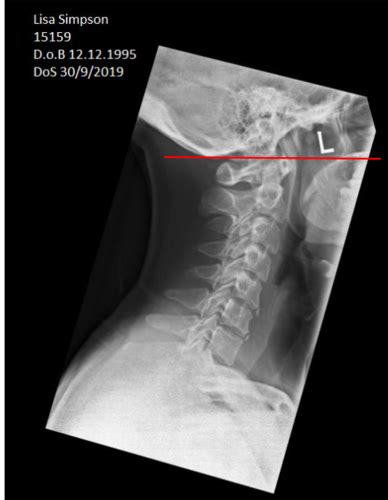 Radiographic Evaluation Flashcards Quizlet