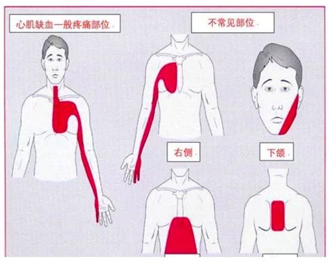 心绞、心梗、心衰经典总结，一文搞定！ 丁香园