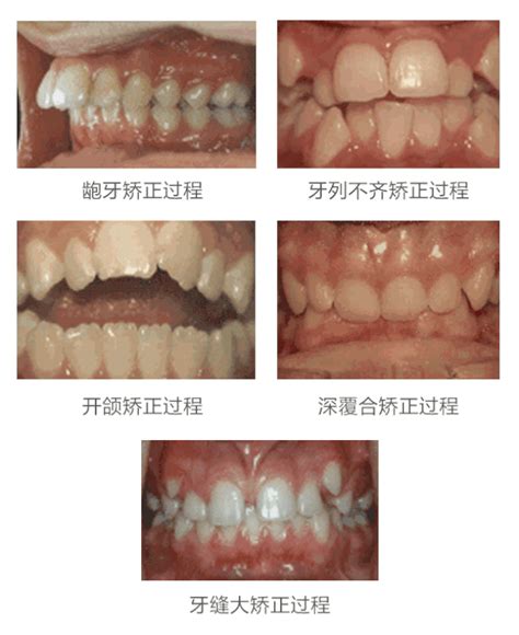 儿童牙齿“地包天”？尽早干预矫正很关键 知乎