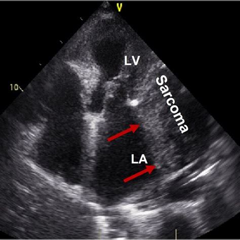 Chest Xray A And Transthoracic Echocardiography B And C Shows A