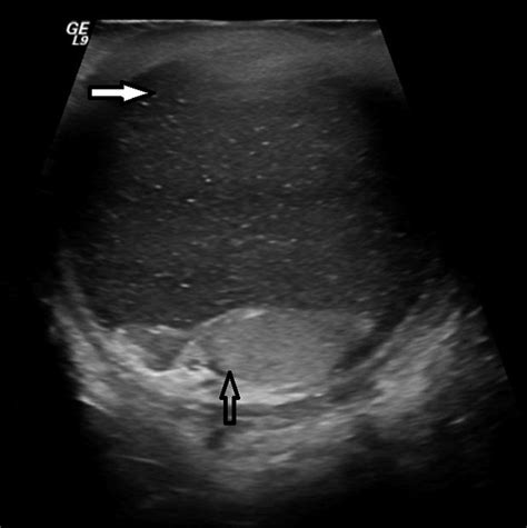 Ultrasound Of Right Scrotum Sagittal View Showing The Fluid