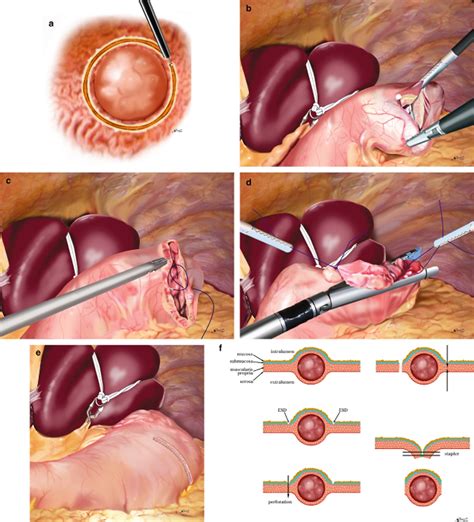 Laparoscopic Endoscopic Cooperative Surgery Hiki 2015 Digestive