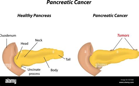 Pancreas Cancer Im Genes Vectoriales De Stock Alamy