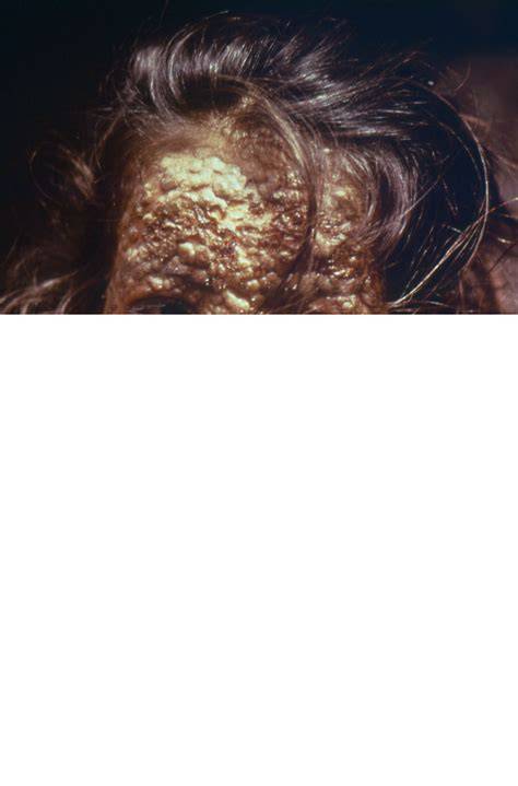 Measles Outbreak 2025--RFK Jr's Misinformation Is Making It Worse