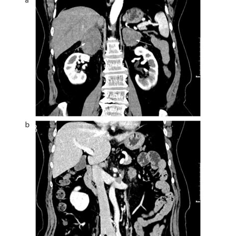 A B Contrast Enhanced Spiral Computed Tomography CT Showed Mild To