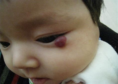 Superficial Hemangioma Of The Central Part Of The Face Periorbital