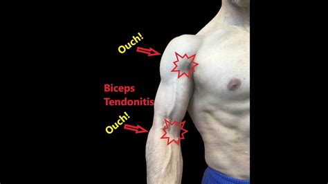 Biceps Tendonitis - Stretches and Fascial Release - YouTube | Bicep ...