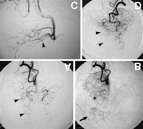 A C Right Vertebral Angiograms Performed In The Initial Hospital