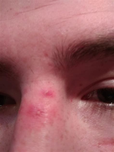 Прыщ на носу - Вопрос дерматологу - 03 Онлайн