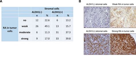 Stromal Expression Of Aldh1 In Human Breast Carcinomas Indicates