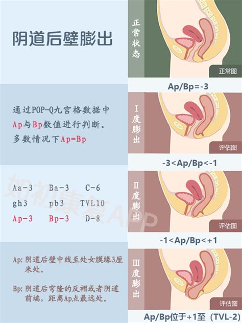 产后子宫脱垂程度and阴道壁膨出程度判断方法 知乎