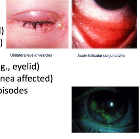 Conjunctiva Part Ii Flashcards Quizlet