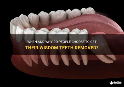 When And Why Do People Choose To Get Their Wisdom Teeth Removed Medshun