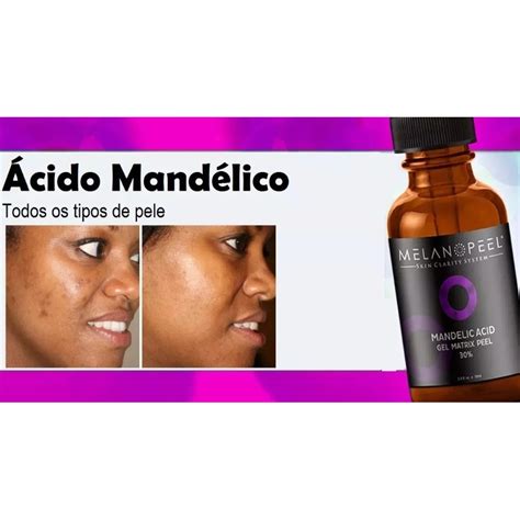 Cuidado Facial Para Manchas E Melasmas Peeling Mand Lico Solu O