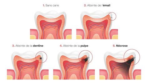 Comment évolue une carie dentaire Oral Care