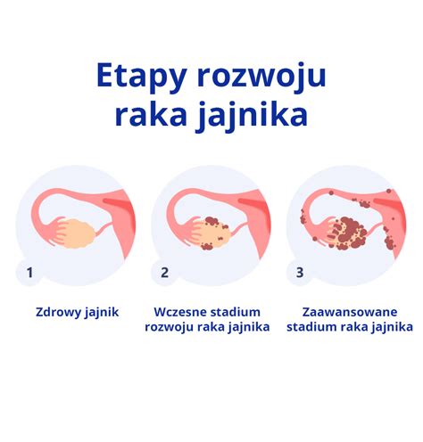 Rak Jajnika Objawy Diagnostyka I Rokowanie