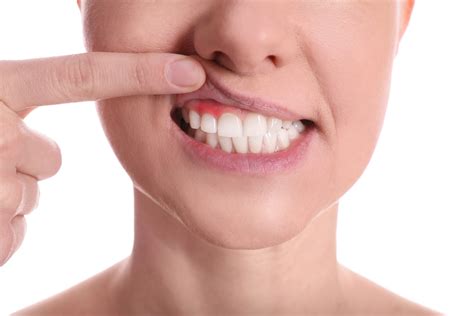 Cómo tratar la gingivitis en Las Palmas Clínica Dental GEO