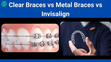 Clear Braces Vs Metal Braces Vs Invisalign Guide