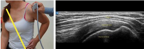 Quick Guide To Shoulder Ultrasound Sports Medicine Review