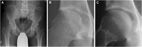 Anterior Posterior And Frog Leg Lateral Radiographs Of A Patient With