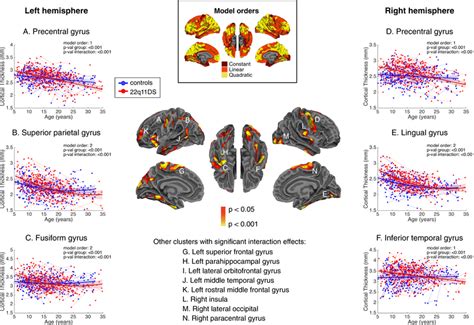 Significant Shape Differences In Cortical Thickness Between 22q11ds And