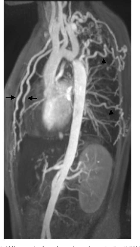 Figure 2 From Mri In Adult Patients With Aortic Coarctation Diagnosis And Follow Up Semantic