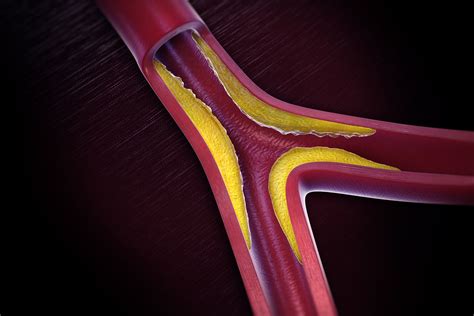 Peripheral Artery Disease: Symptoms, Causes, and Diagnosis