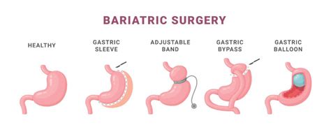 Gastric Bypass Versus Gastric Sleeve Cost Benefits And Key Differences