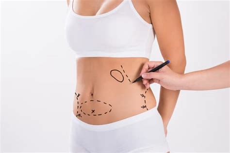 Quels Sont Les Risques D Une Abdominoplastie Dr Ktorza