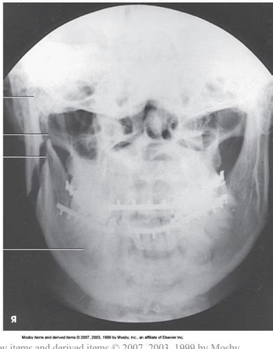 Mandible Tmj And Sinuses Projections Flashcards Quizlet