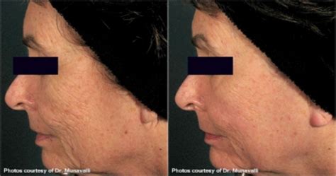 Laser Skin Resurfacing5 Long Island Dermatology