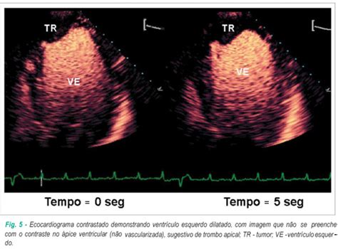 SciELO Brasil Uso da ecocardiografia contrastada para avaliação de