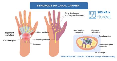 Opération canal carpien symptômes photos et vidéos