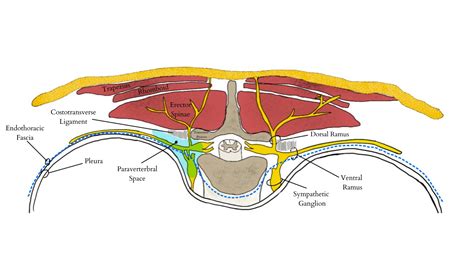 Paravertebral Block