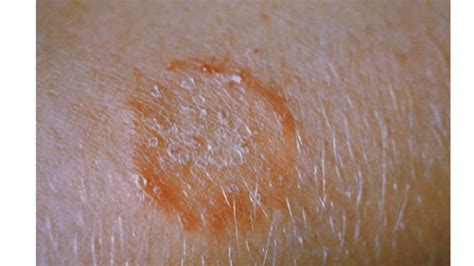 Spongiotic Dermatitis: Causes, Symptoms and Treatment - Bloomsies