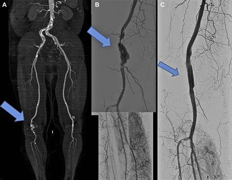 Popliteal Artery