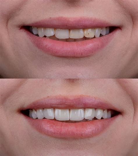 Before And After Of Smile Makeover By Dental Ceramic Veneer Porcelain