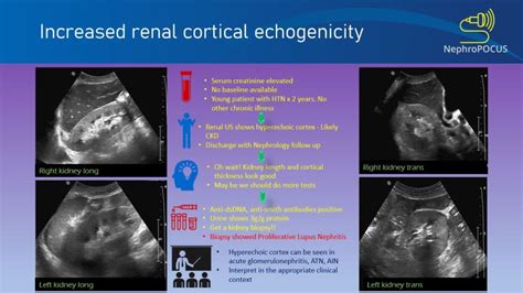 Increased renal cortical echogenicity does not always indicate chronic ...