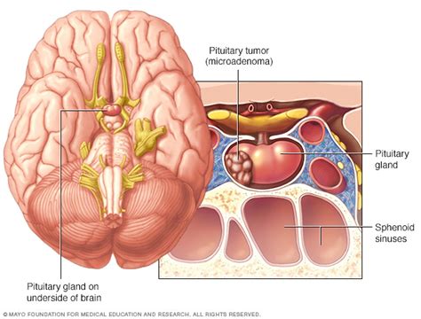 Pituitary Tumors Disease Reference Guide