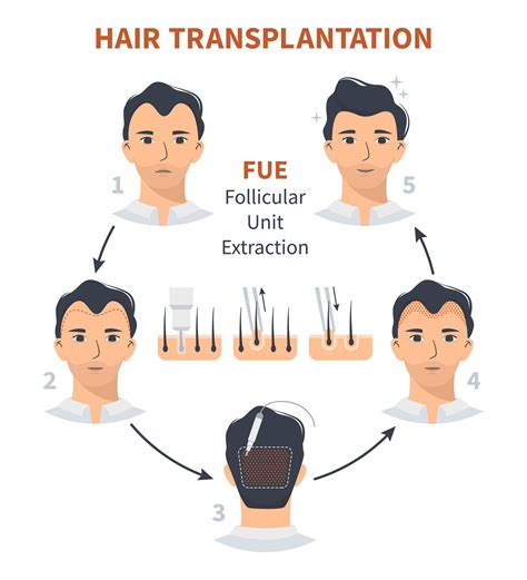 Stages Of Hair Transplantation Fue Unit Extraction 3238412 Vector Art