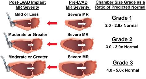 Frontiers Role Of The Mitral Valve In Left Ventricular Assist Device