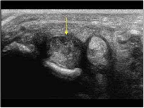 Posterior Tibial Tendon Synovitis