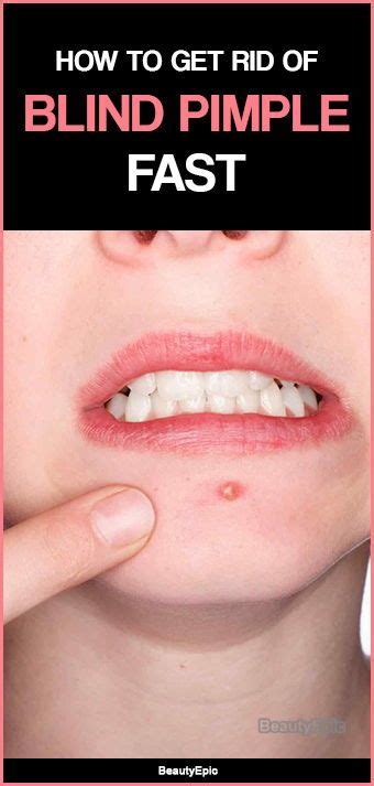 How To Get Rid Of Blind Pimple Blind Pimple How To Cure Pimples Pimples