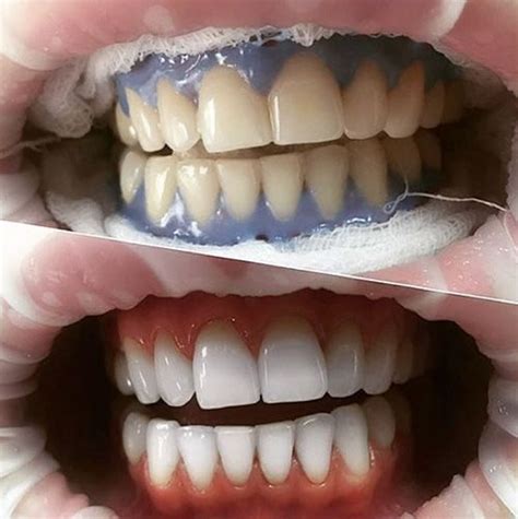 Отбеливание зубов в Алматы: цена, гарантия - DentalPark