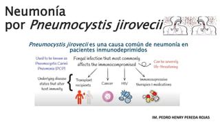 Neumonía por Pneumocystis jirovecii pptx