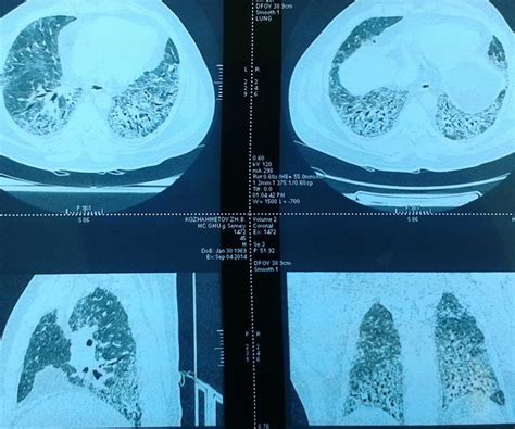 CT-scan of the patient with Idiopathic Pulmonary Fibrosis | Download ...