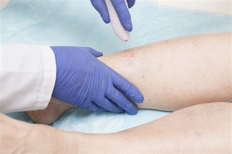 Vein Treatment - Stoughton Health