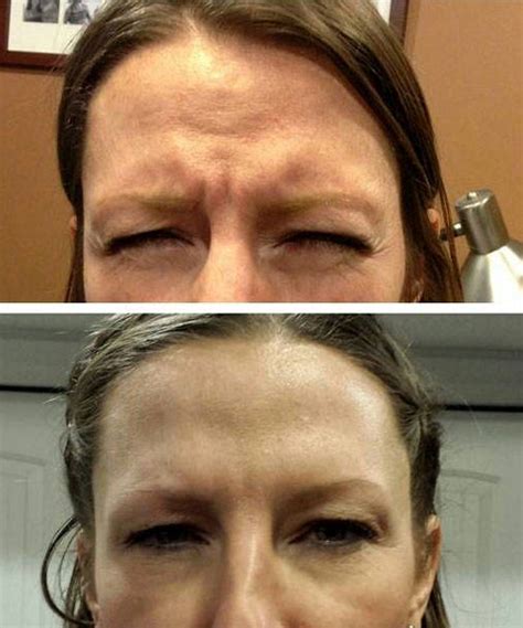 What Is A Botox Brow Lift Eyelid Surgery Cost Photos Rewiews Q A