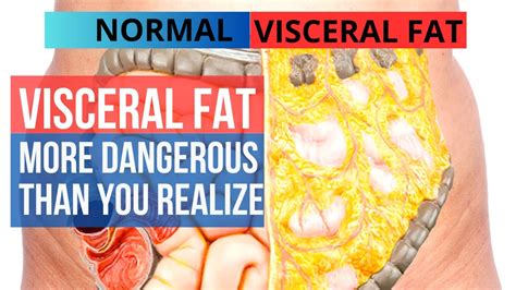 Why Visceral Fat Is More Dangerous Than You Think The Role Of